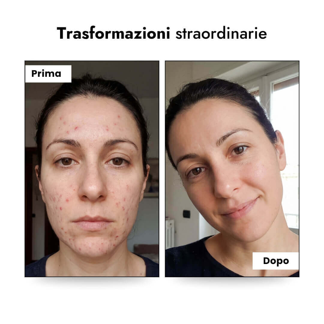 LumiSkin™ Pro - Trattamento Alta Frequenza Luvia