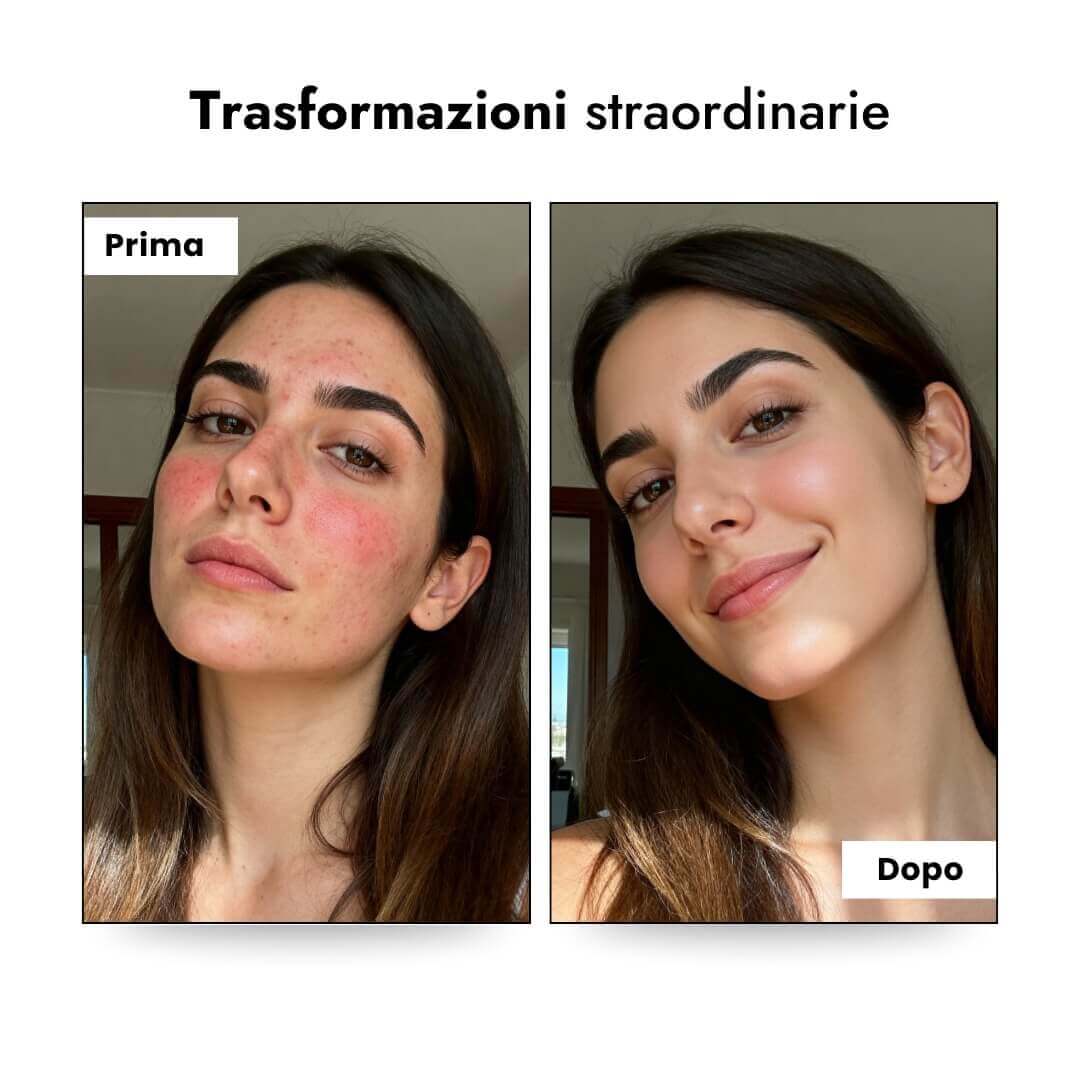 LumiSkin™ Pro - Trattamento Alta Frequenza Luvia