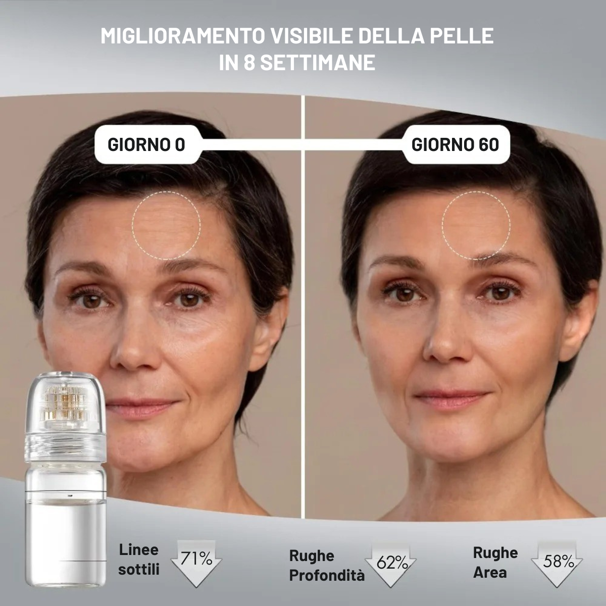 Micro-Infusion Kit Luvia